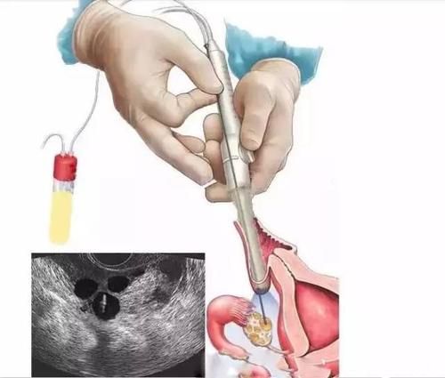 (河南代生妈妈)子宫积水对怀孕有影响吗，能否做赠卵试管代生价格分两种情况