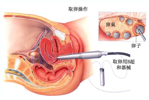 华西附二院试管成功率高吗
